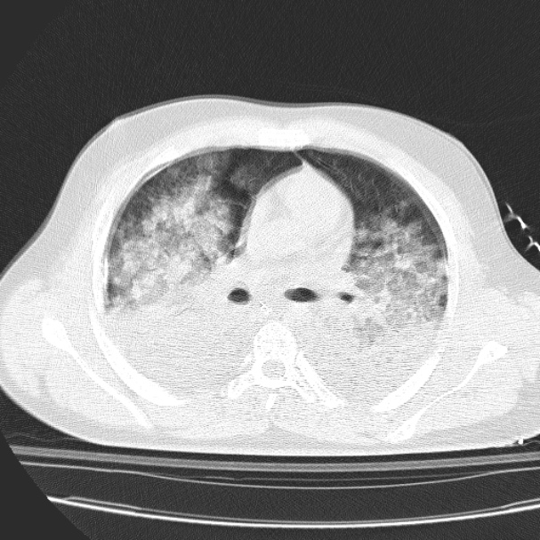Acute aspiration pneumonitis (Radiopaedia 33605-34703 Axial lung window 46).jpg