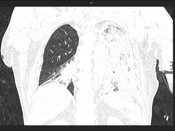 Acute aspiration pneumonitis (Radiopaedia 55642-62166 Coronal lung window 73).jpg