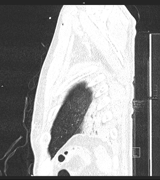 Acute aspiration pneumonitis (Radiopaedia 55642-62166 Sagittal lung window 6).jpg