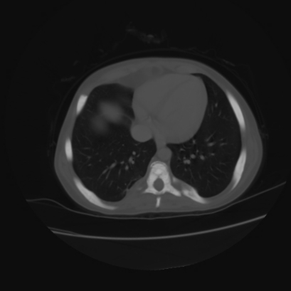 File:Acute calculous cholecystitis in patient with osteopetrosis (Radiopaedia 77871-90159 Axial bone window 2).jpg