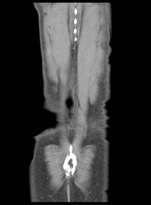 Acute cholecystitis (Radiopaedia 29814-30327 Coronal C+ portal venous phase 49).jpg