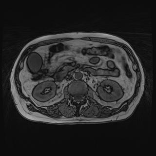 File:Acute cholecystitis (Radiopaedia 72392-82923 Axial T1 out-of-phase 67).jpg