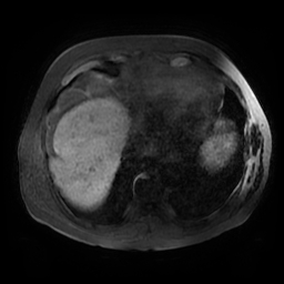 Acute cholecystitis complicated by pylephlebitis (Radiopaedia 65782-74915 Axial T1 fat sat 3).jpg
