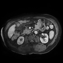 Acute cholecystitis complicated by pylephlebitis (Radiopaedia 65782-74915 Axial arterioportal phase T1 C+ fat sat 87).jpg