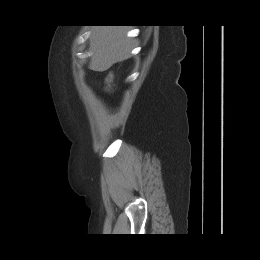 File:Acute cholecystitis with tensile fundus sign (Radiopaedia 71394-81723 Sagittal non-contrast 39).jpg