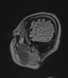 Acute disseminated encephalomyelitis (ADEM)- Anti-NMDA receptor encephalitis (Radiopaedia 54920-61201 Sagittal FLAIR 16).png
