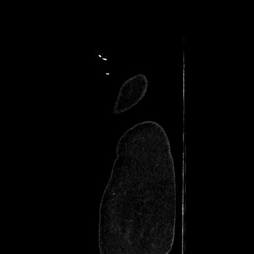 Acute diverticulitis - transverse colon (Radiopaedia 87063-103327 Sagittal C+ portal venous phase 231).jpg