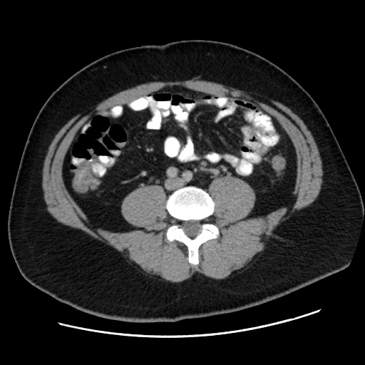 File:Acute diverticulitis with localized perforation (Radiopaedia 41296-44113 Axial C+ portal venous phase 56).jpg