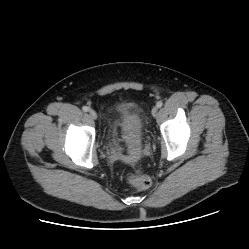 Acute diverticulitis with localized perforation (Radiopaedia 41296-44113 Axial C+ portal venous phase 83).jpg