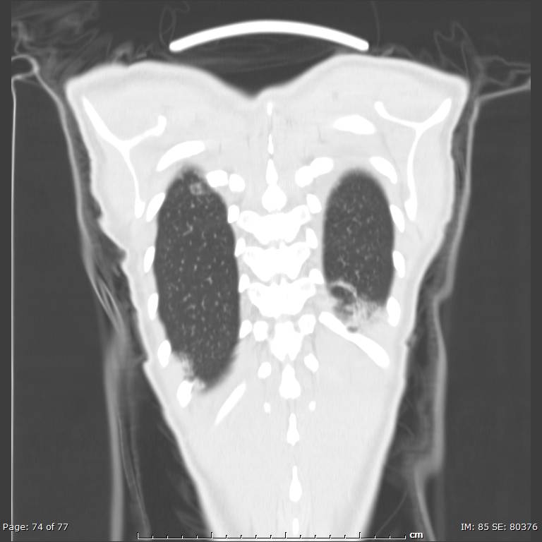 Acute eosinophilic pneumonia (Radiopaedia 48211-53073 Coronal lung window 51).jpg