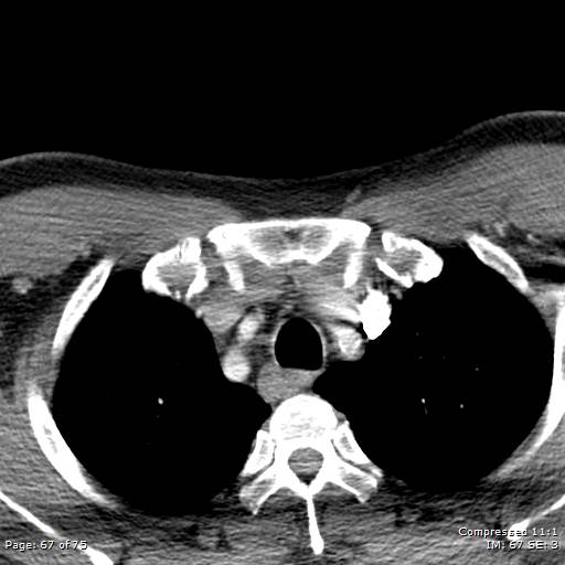 Acute epiglottitis (Radiopaedia 54375-60590 Axial C+ arterial phase 67).jpg
