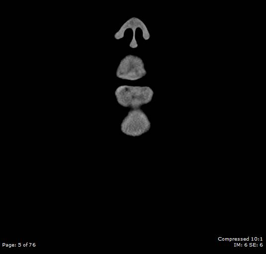 Acute epiglottitis (Radiopaedia 54375-60590 Coronal C+ arterial phase 5).jpg