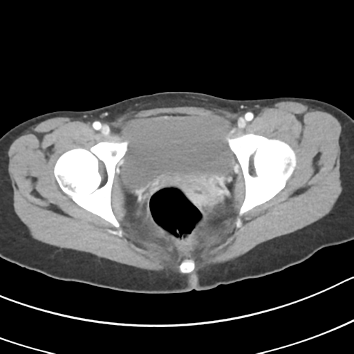 Acute gangrenous appendicitis with perforation (Radiopaedia 40152-42662 Axial C+ portal venous phase 71).png