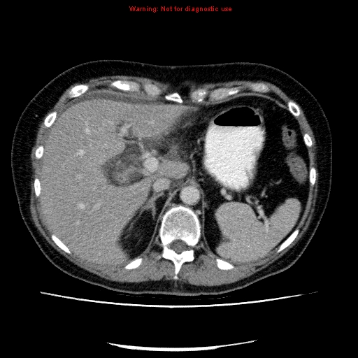 Acute gangrenous cholecystitis (Radiopaedia 10123-10661 Axial C+ portal venous phase 24).jpg