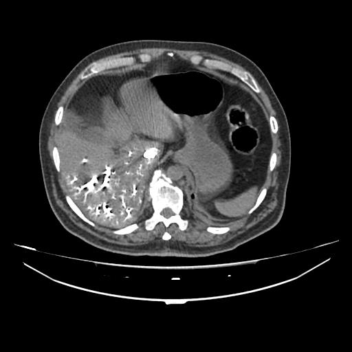 Acute heart failure (CT) (Radiopaedia 79835-93075 Axial C+ arterial phase 76).jpg