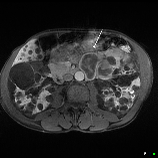 File:Acute hemorrhage in a renal cyst in polycystic disease (MRI) (Radiopaedia 41702-44642 Axial T1 C+ fat sat 1).jpg