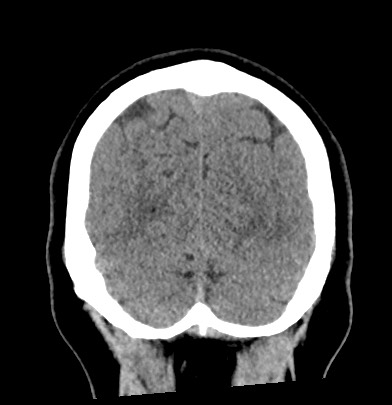 Acute internal carotid artery dissection (Radiopaedia 53541-59558 Coronal non-contrast 65).jpg