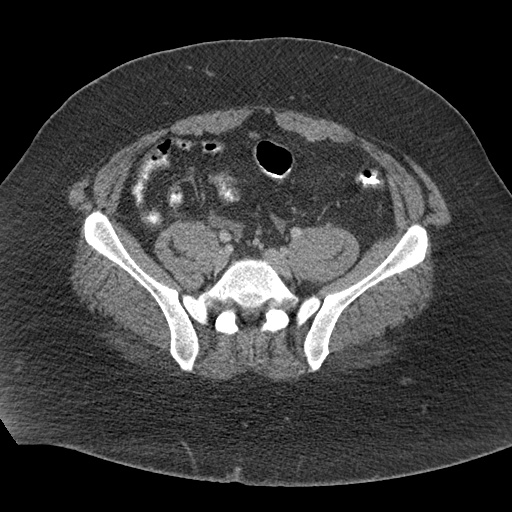 Acute mesenteric venous ischemia (Radiopaedia 46041-50383 Axial C+ portal venous phase 101).jpg