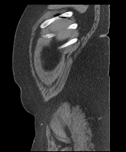 Acute mesenteric venous ischemia (Radiopaedia 46041-50383 Sagittal C+ portal venous phase 9).jpg