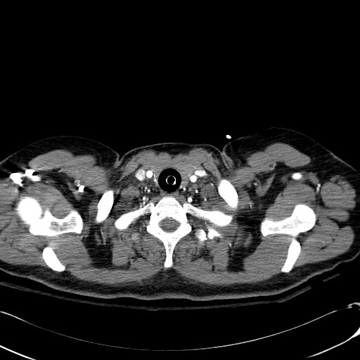 File:Acute myocardial infarction in CT (Radiopaedia 39947-42415 Axial C+ arterial phase 4).jpg