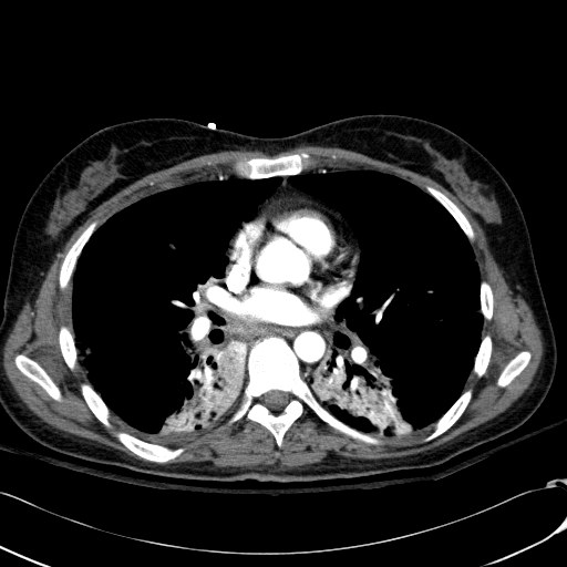 File:Acute myocardial infarction in CT (Radiopaedia 39947-42415 Axial C+ arterial phase 72).jpg