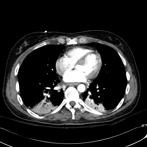 File:Acute myocardial infarction in CT (Radiopaedia 39947-42415 Axial C+ arterial phase 88).jpg