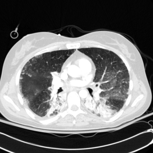 File:Acute myocardial infarction in CT (Radiopaedia 39947-42415 Axial lung window 63).jpg