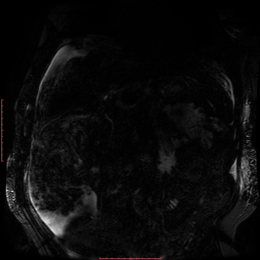 Acute necrotizing pancreatitis (Radiopaedia 28194-28448 Coronal MRCP 51).jpg