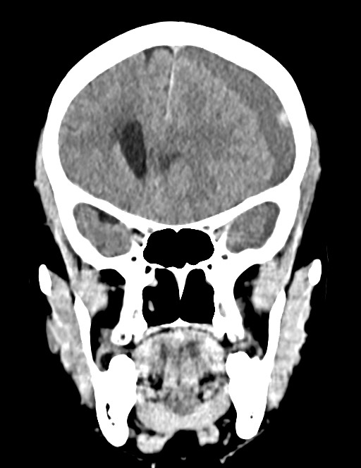 Acute on chronic subdural hematoma (Radiopaedia 74814-85823 Coronal non-contrast 24).jpg