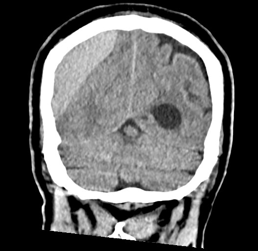 Acute on chronic subdural hematoma (Radiopaedia 78346-90966 Coronal non-contrast 52).jpg