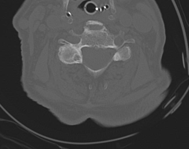 Acute on chronic subdural hematoma and thoracic vertebral injury in a multitrauma patient (Radiopaedia 31698-32619 Axial bone window 35).jpg
