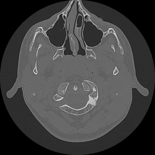 Acute otomastoiditis and Bezold abscess (Radiopaedia 88184-104786 Axial bone window 6).jpg