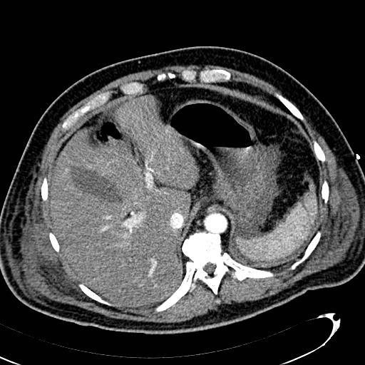 File:Acute pancreatic necrosis (Radiopaedia 13560-13486 Axial C+ portal venous phase 34).jpg