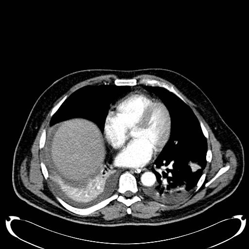 Acute pancreatic necrosis (Radiopaedia 13560-18500 Axial C+ portal venous phase 9).jpg