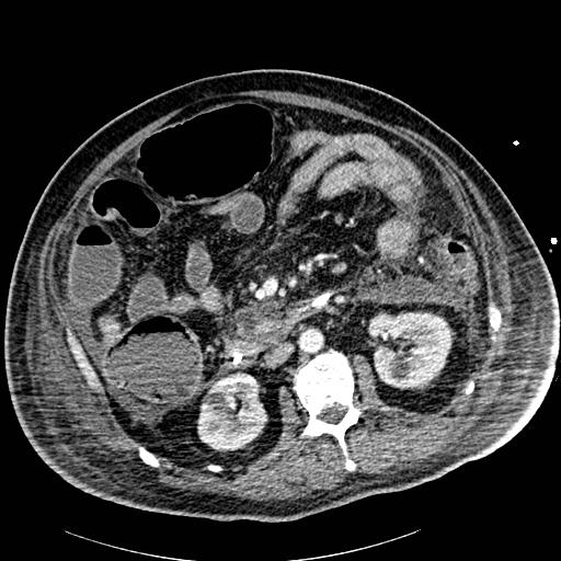 Acute pancreatic necrosis (Radiopaedia 13560-18502 Axial C+ portal venous phase 46).jpg