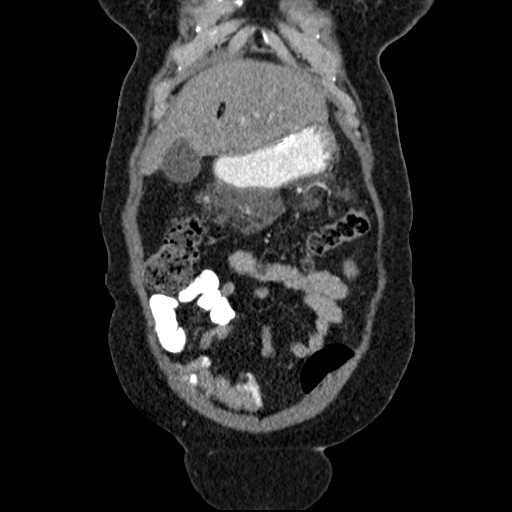 File:Acute pancreatitis (Radiopaedia 20829-20744 Coronal C+ portal venous phase 12).jpg