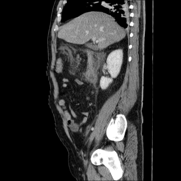 Acute pancreatitis (Radiopaedia 26663-26813 Sagittal C+ portal venous phase 26).jpg