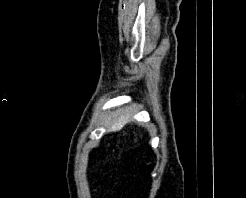 Acute pancreatitis (Radiopaedia 85146-100701 Sagittal C+ portal venous phase 1).jpg