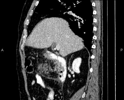 Acute pancreatitis (Radiopaedia 85146-100701 Sagittal C+ portal venous phase 31).jpg