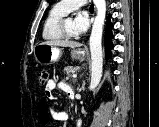 Acute pancreatitis (Radiopaedia 85146-100701 Sagittal C+ portal venous phase 56).jpg