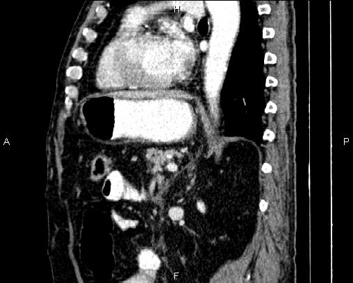 Acute pancreatitis (Radiopaedia 85146-100701 Sagittal C+ portal venous phase 60).jpg