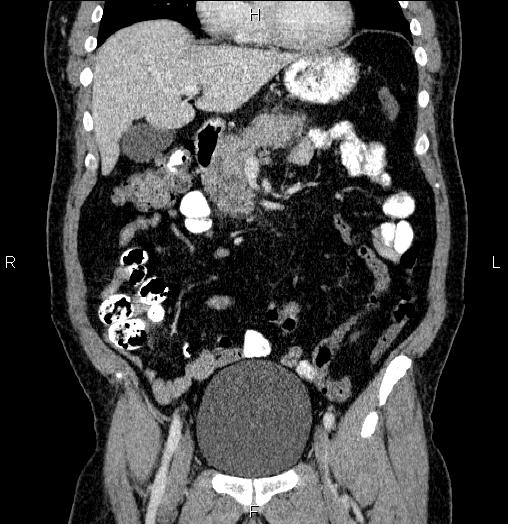 Acute pancreatitis (Radiopaedia 85390-101010 Coronal C+ portal venous phase 25).jpg