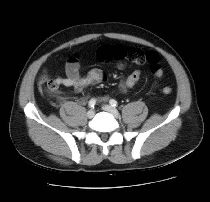 Acute pancreatitis - Balthazar E (Radiopaedia 23080-23110 Axial C+ portal venous phase 49).jpg