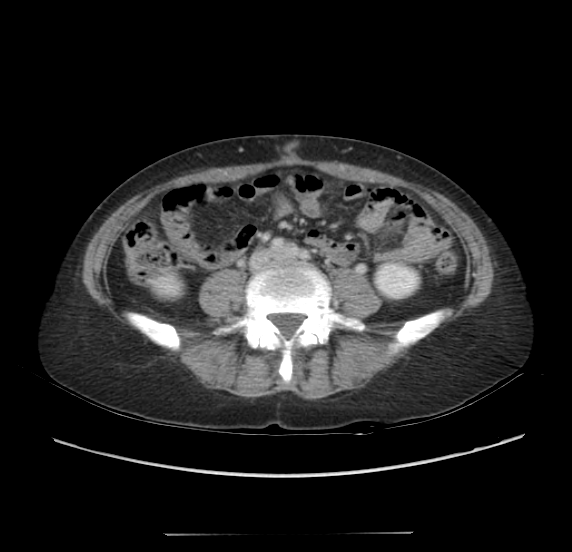 File:Acute pancreatitis - Balthazar E - post ERCP (Radiopaedia 27562-27772 Axial C+ portal venous phase 46).png