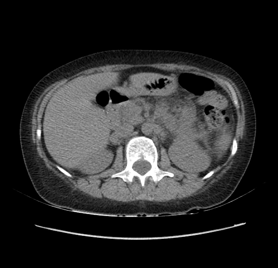 File:Acute pancreatitis - Balthazar E - post ERCP (Radiopaedia 27562-27772 Axial non-contrast 21).png