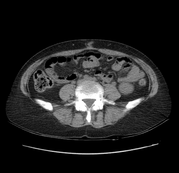 File:Acute pancreatitis - Balthazar E - post ERCP (Radiopaedia 27562-27772 Axial non-contrast 39).png