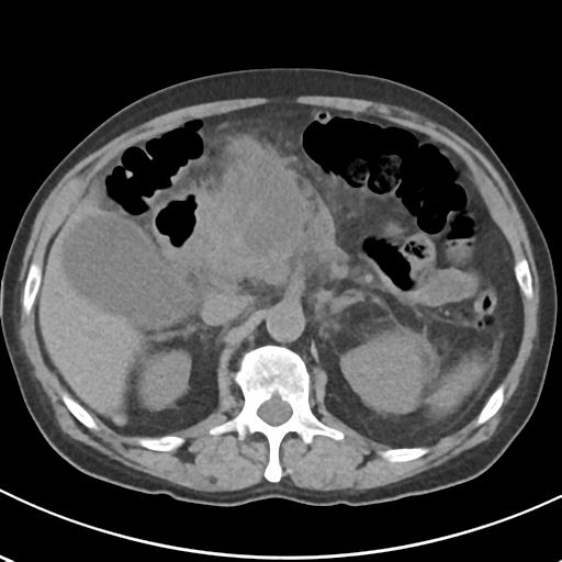 File:Acute pancreatitis and walled-off necrosis (Radiopaedia 29888-30404 Axial non-contrast 27).jpg