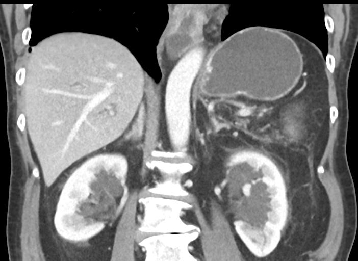 Acute pancreatitis and walled-off necrosis (Radiopaedia 29888-30404 Coronal C+ portal venous phase 33).jpg