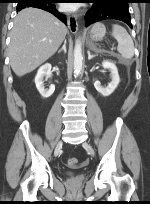 Acute pancreatitis complicated by portal vein thrombus (Radiopaedia 48148-52990 Coronal C+ portal venous phase 40).png
