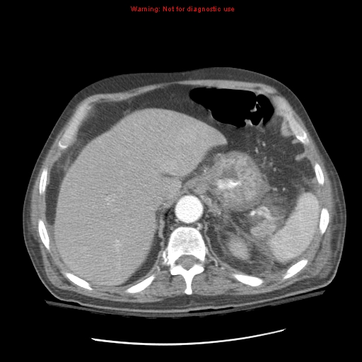 Acute pancreatitis with incidental pancreatic lipoma (Radiopaedia 10190-10730 Axial C+ arterial phase 24).jpg